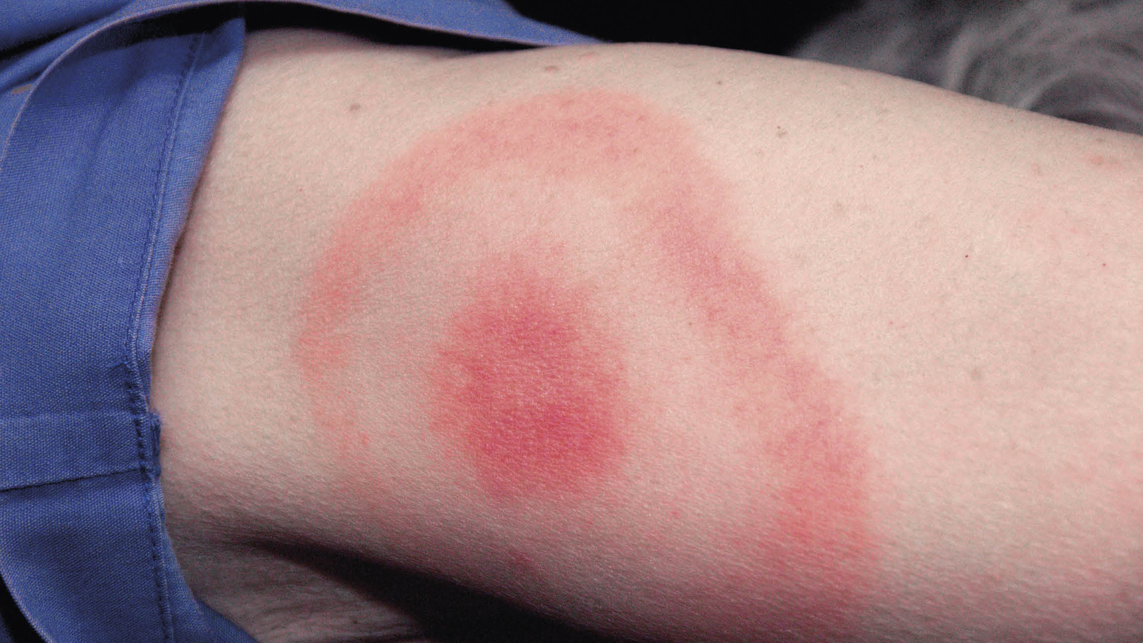 Medan det går att vaccinera sig mot virussjukdomen TBE, saknas det sådant mot borrelia. Därför gäller det att skydda sig så gott det går genom täckande kläder och fästingmedel –...